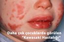 Avrupa'da Kawasaki Hastalığı şüphesi taşıyan çocuk sayısında artış gözlemlendi.